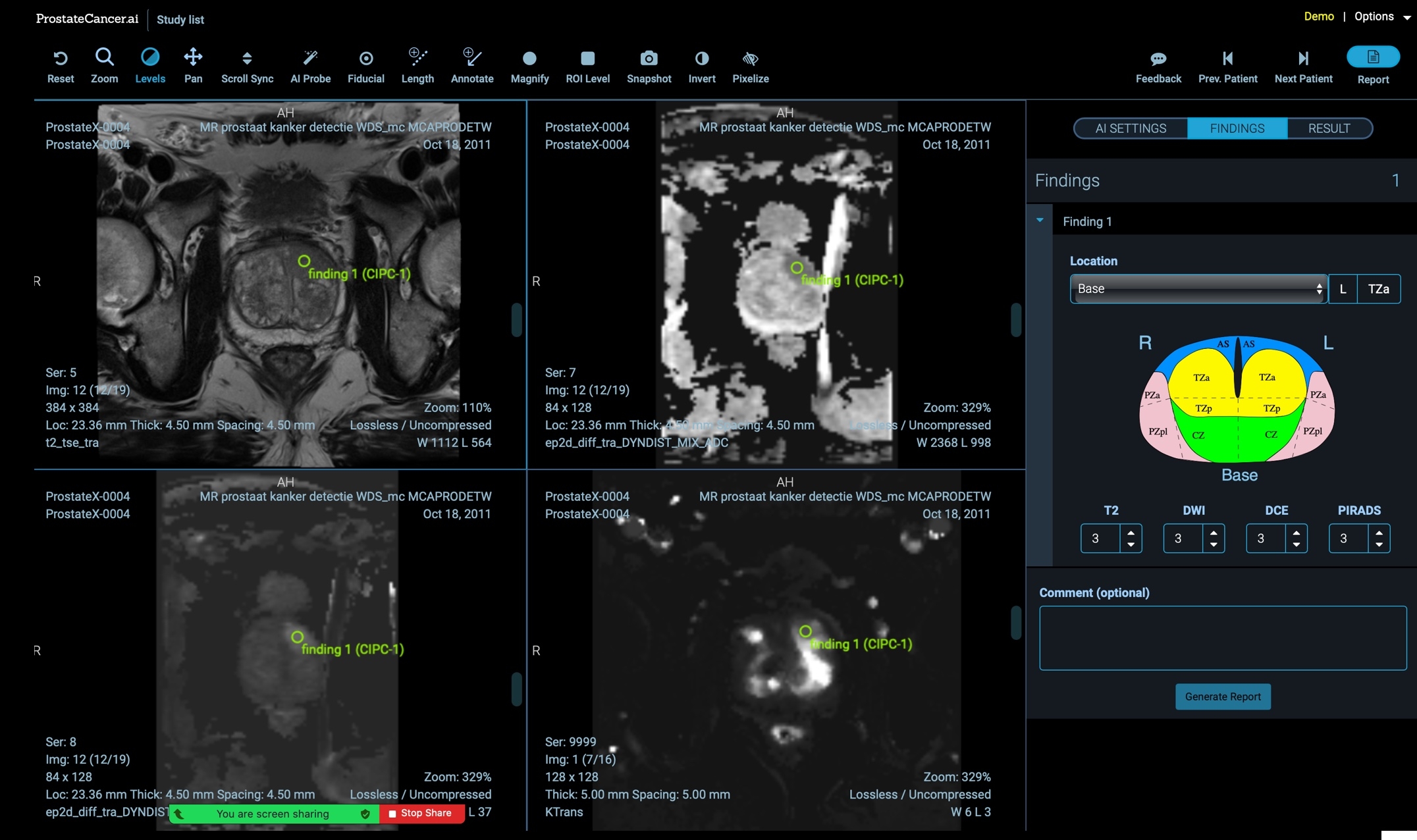 ProstateCancer.ai